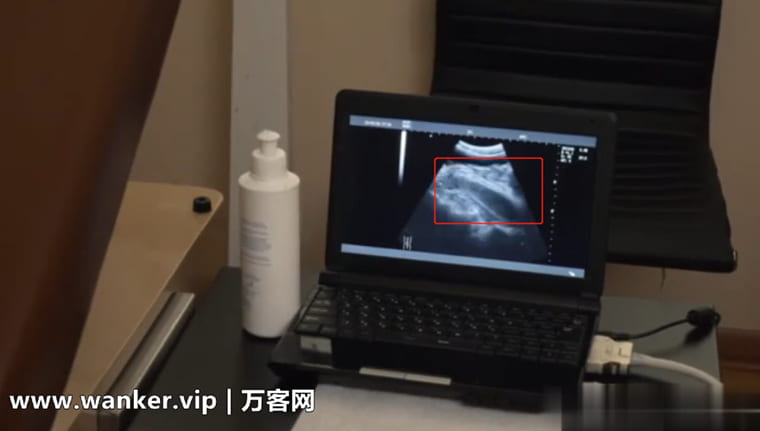 Advancing under B-ultrasound-Wanke Video